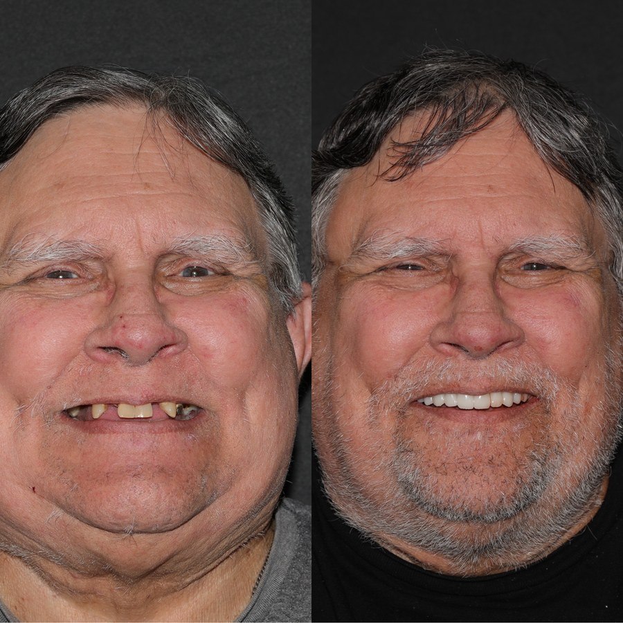 Full-face before and after restorative smile transformation