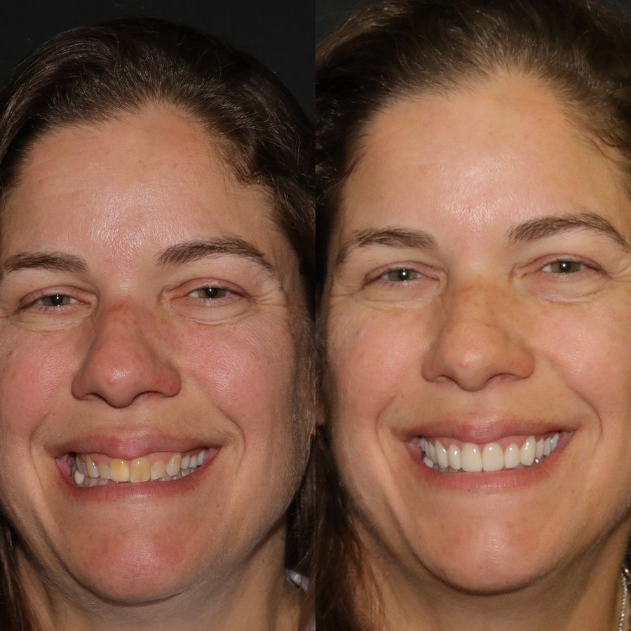 Approved full-face before and after cosmetic smile transformation