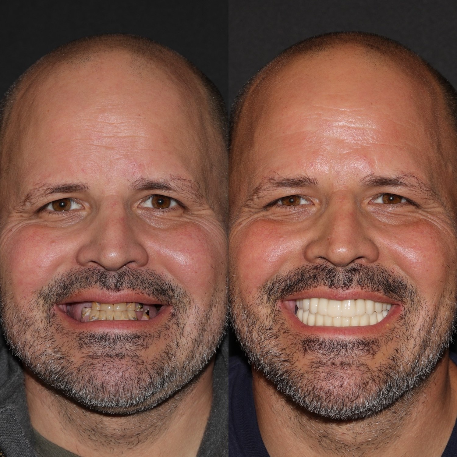 Approved patient full-face before and after smile transformation