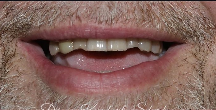 Crown rejuvenation