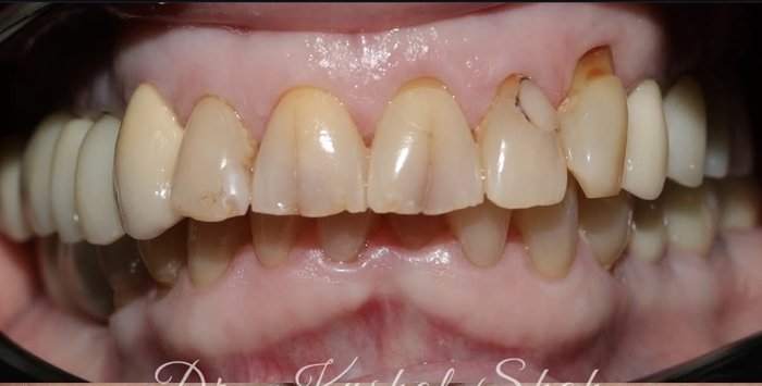 Female crown makeover