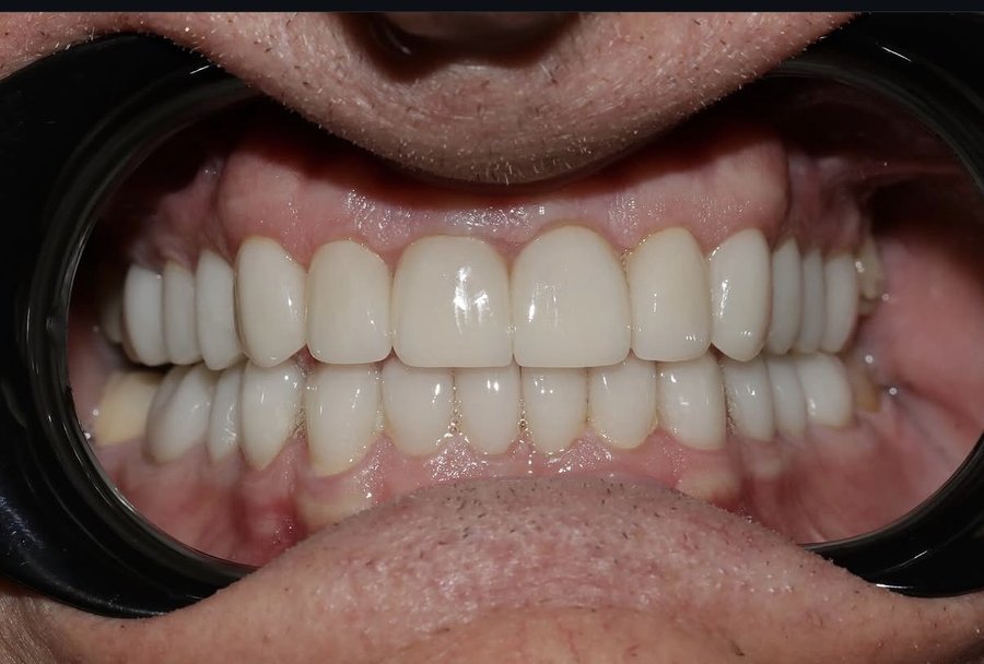 Full arch implant result