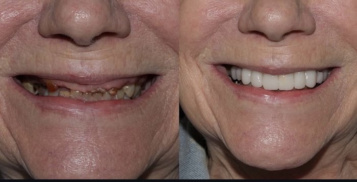 Chipped tooth repair