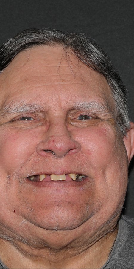 Male full mouth reconstruction