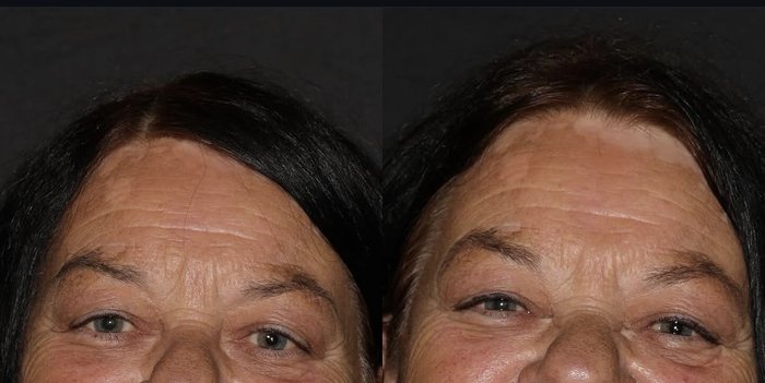 Missing tooth implant