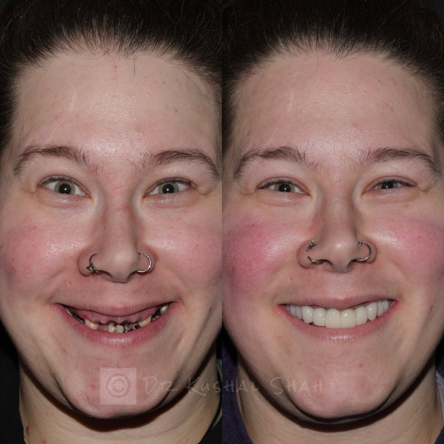 Implants