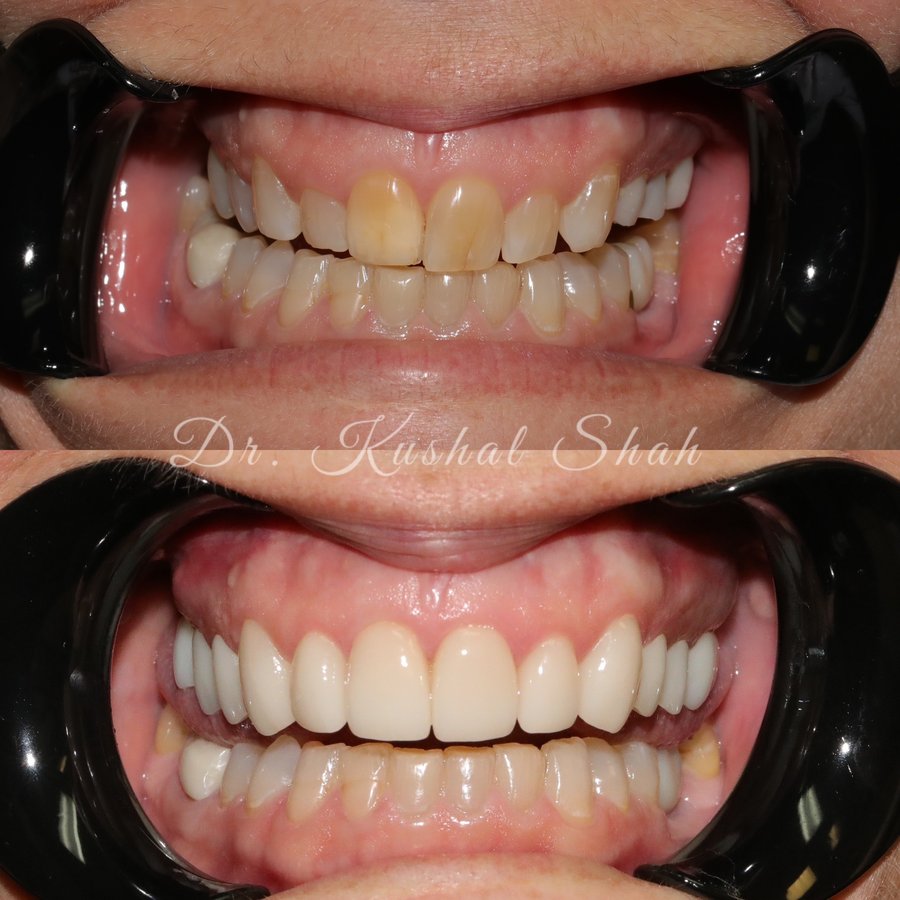 Veneers