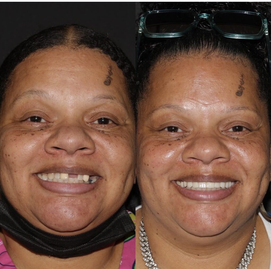 Patient smile transformation, before and after