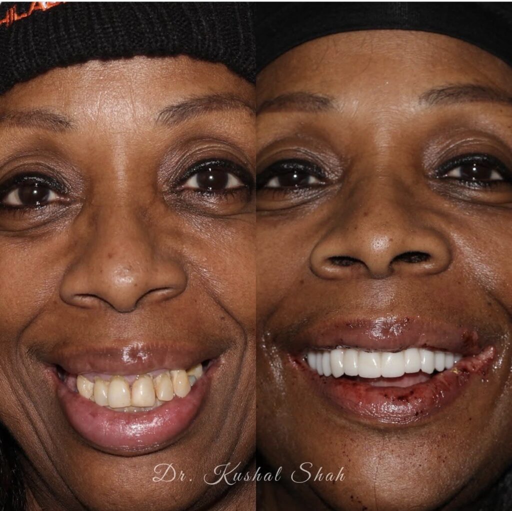 Patient smile transformation, before and after