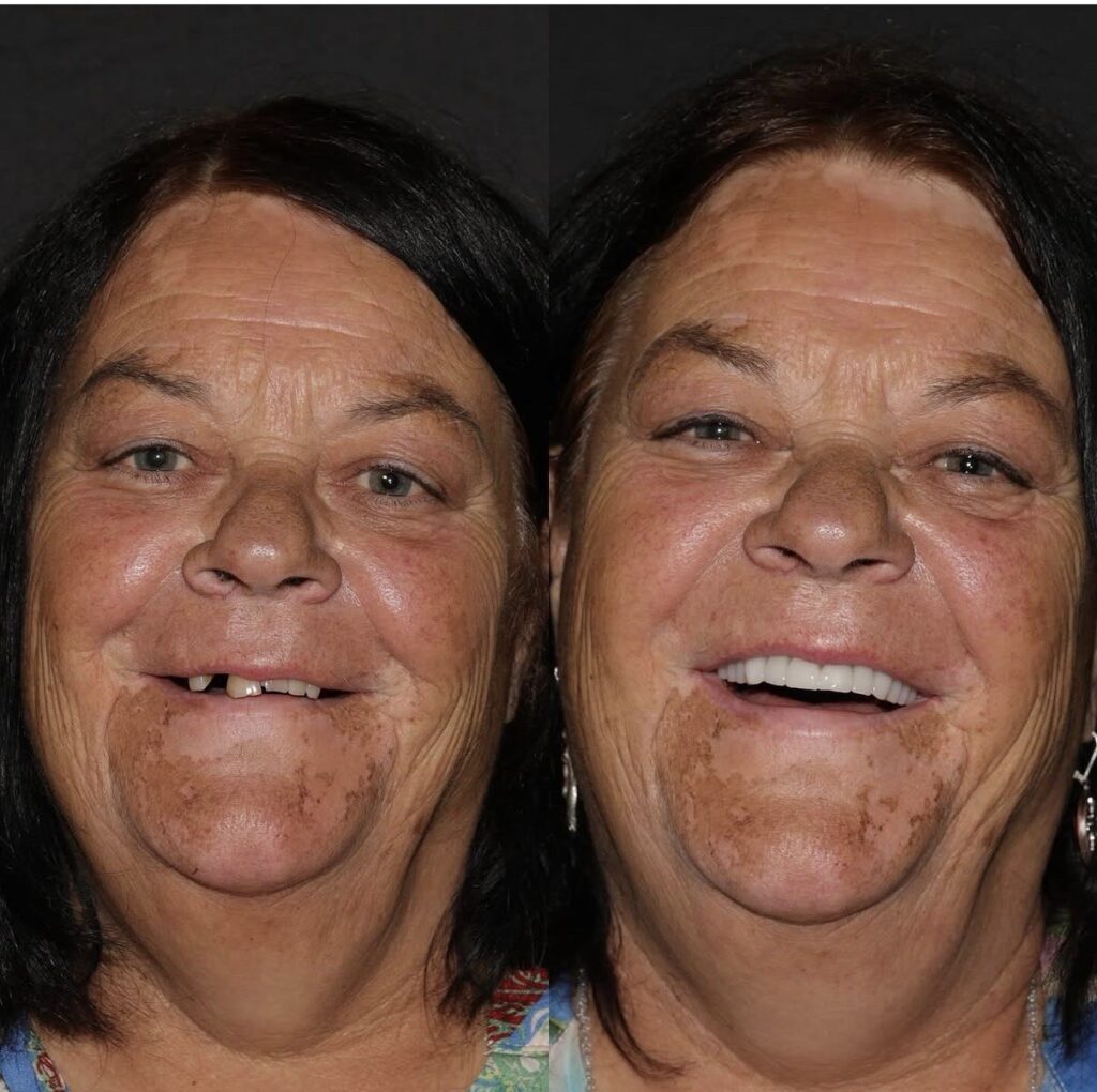 Patient smile transformation, before and after